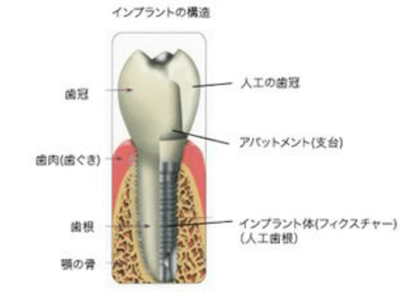 インプラント２